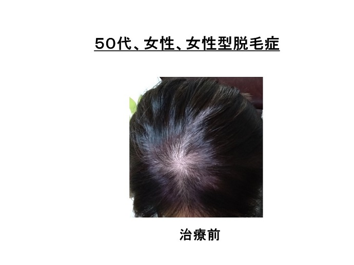 円形脱毛症　病院